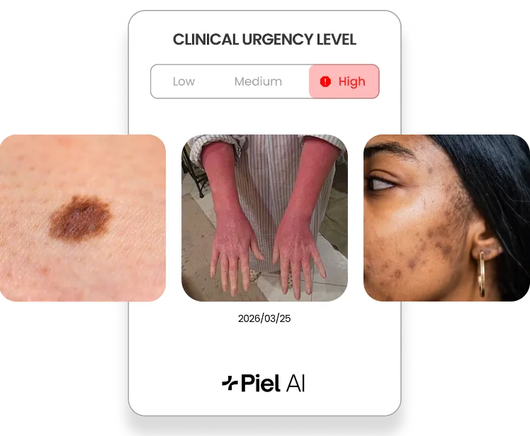 Understand skin condition severity with Piel AI